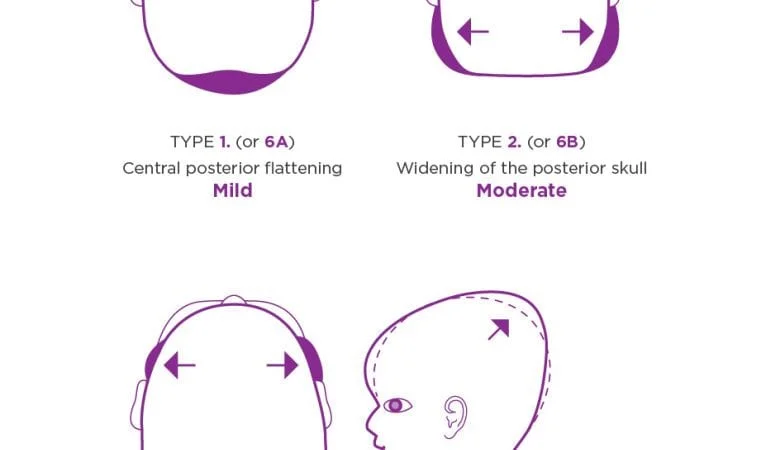 Brachycephaly: Causes, Diagnosis, and Treatment