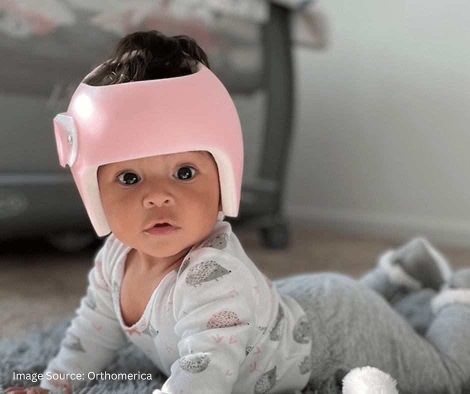 Cranial Helmets for Babies: Parent's Guide