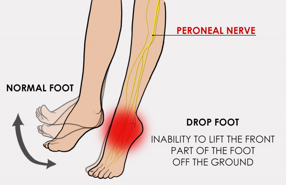 Foot Drop: Causes, Symptoms, and Treatment Options