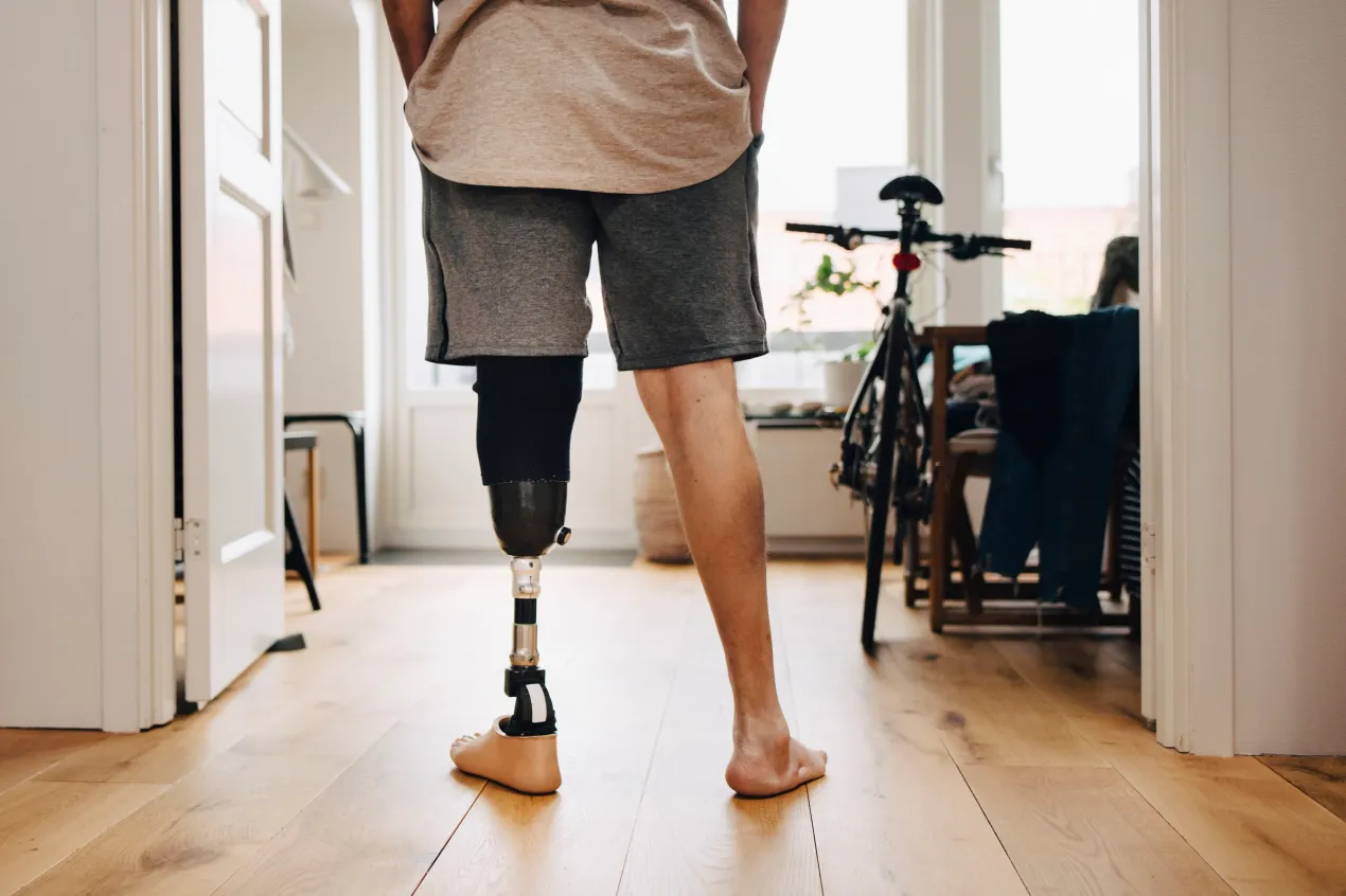 Living Well with a Prosthetic Limb