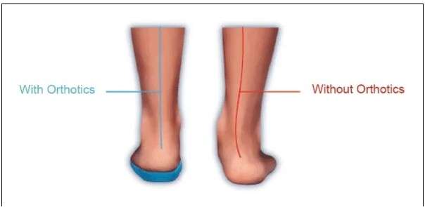 Understanding Plantar Fasciitis: What It Is and How to Manage the Pain