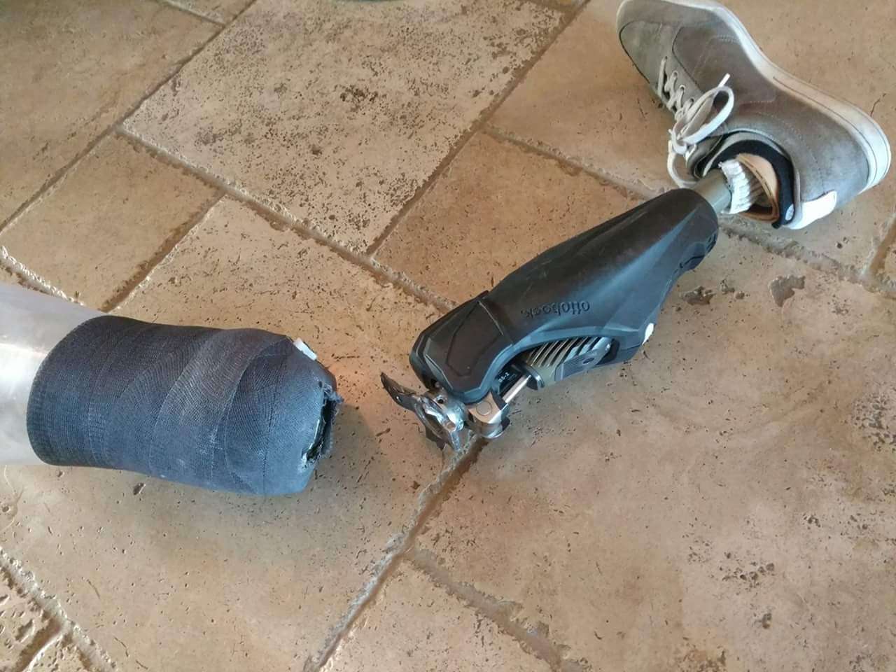 What to Do in a Prosthetic Emergency: When Things Break or Get Stuck