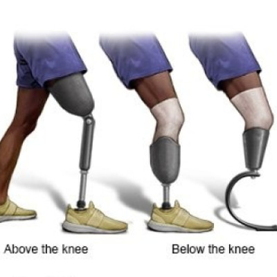 Adjusting to Life with a Prosthetic Limb: First Steps, Challenges, and How to Overcome Them[Draft]